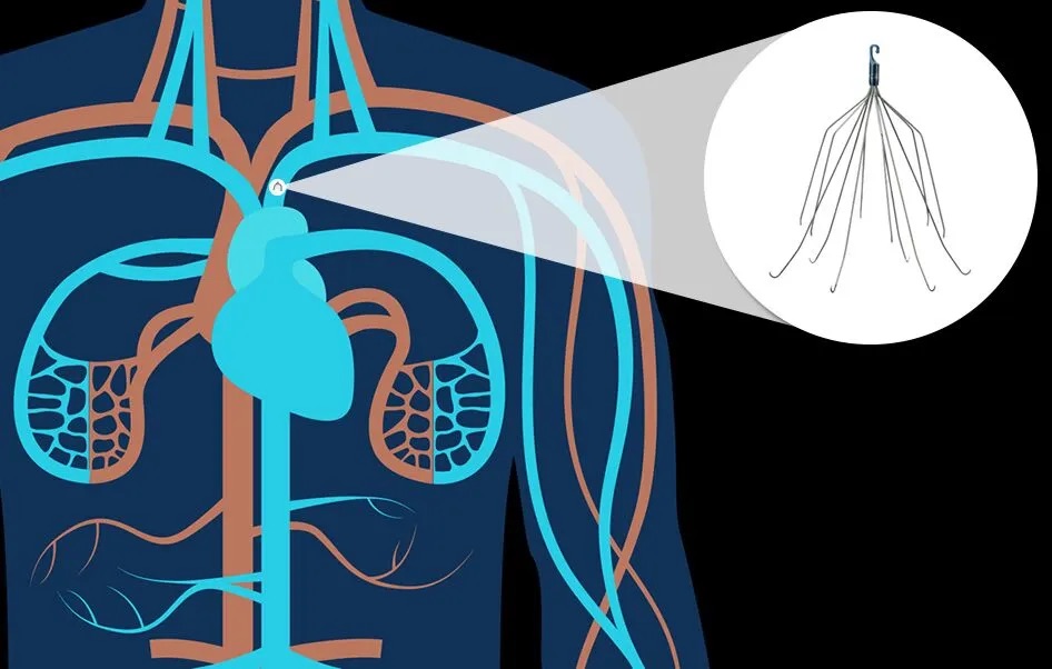 IVC Filter Complications: What You Need To Know