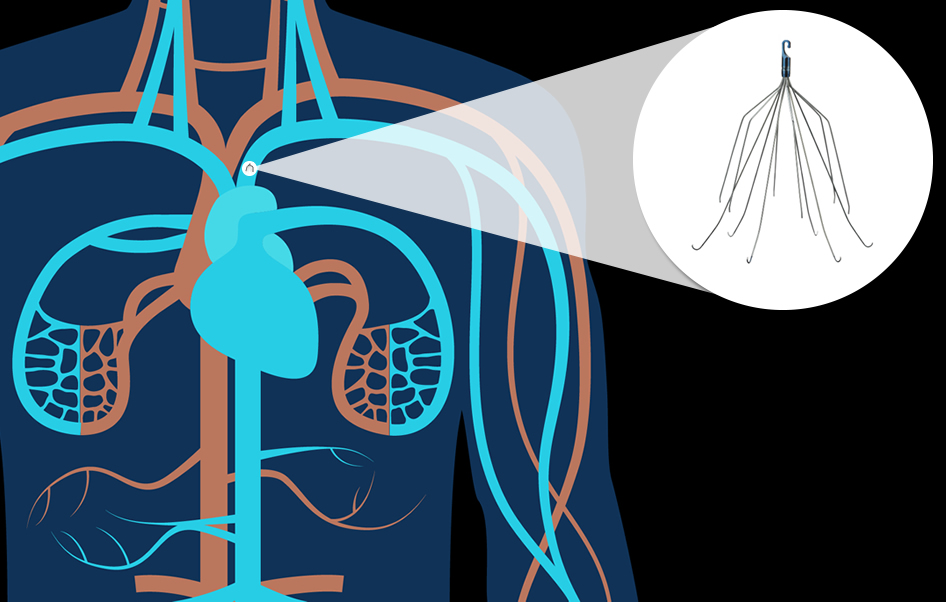 IVC filter complications