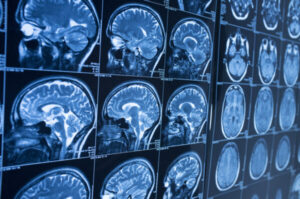 Call Our College Park Brain Injury Lawyers to Schedule a Free Consultation
