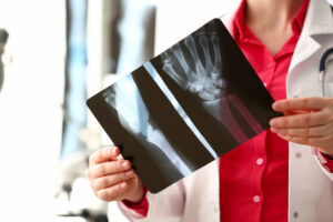 What Is a Broken Bone?