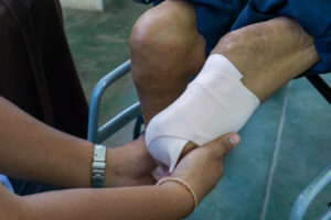 What Is an Amputation Injury?