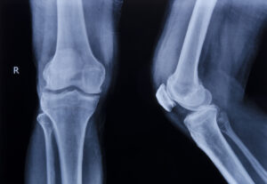 Common Injuries That Qualify for Compensation After an Amazon Delivery Vehicle Accident