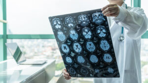 Signos y síntomas comunes de una lesión cerebral