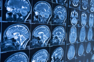 ¿Por qué debería contratar a Rafi Law Firm tras sufrir una lesión cerebral en College Park, Georgia?